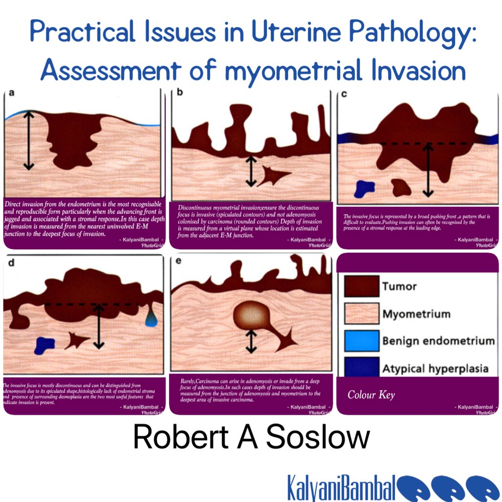 Kalyani Bambal (@kriyer68) on Twitter photo PRACTICAL ISSUES RELATED TO UTERINE PATHOLOGY:
Assessment of myometrial Invasion.
#gynpath #oncopath #pathclues #pathboards #surgpath
<a href="/GeronimoJrLapac/">Gerônimo Jr.</a> <a href="/mreyesm/">Miguel Reyes-Múgica</a> <a href="/BinXu16/">Bin Xu</a> <a href="/smlungpathguy/">Sanjay Mukhopadhyay</a> <a href="/DraEosina/">Laura G. Pastrián MD</a> <a href="/pembeoltulu/">Pembe Oltulu, MD</a> <a href="/Histopatolomon/">Pascual Meseguer</a> <a href="/DCSkipperDO/">Daniel Skipper</a> <a href="/VijayPatho/">Vijay Shankar S</a> <a href="/EAljufairi/">Eman Aljufairi, MD</a> <a href="/DrAhmedKalebi/">𝗗𝗿 𝗔𝗵𝗺𝗲𝗱 𝗞𝗮𝗹𝗲𝗯𝗶, 𝕆𝔾𝕎</a> PRACTICAL ISSUES RELATED TO UTERINE PATHOLOGY:
Assessment of myometrial Invasion.
#gynpath #oncopath #pathclues #pathboards #surgpath
<a href="/GeronimoJrLapac/">Gerônimo Jr.</a> <a href="/mreyesm/">Miguel Reyes-Múgica</a> <a href="/BinXu16/">Bin Xu</a> <a href="/smlungpathguy/">Sanjay Mukhopadhyay</a> <a href="/DraEosina/">Laura G. Pastrián MD</a> <a href="/pembeoltulu/">Pembe Oltulu, MD</a> <a href="/Histopatolomon/">Pascual Meseguer</a> <a href="/DCSkipperDO/">Daniel Skipper</a> <a href="/VijayPatho/">Vijay Shankar S</a> <a href="/EAljufairi/">Eman Aljufairi, MD</a> <a href="/DrAhmedKalebi/">𝗗𝗿 𝗔𝗵𝗺𝗲𝗱 𝗞𝗮𝗹𝗲𝗯𝗶, 𝕆𝔾𝕎</a>