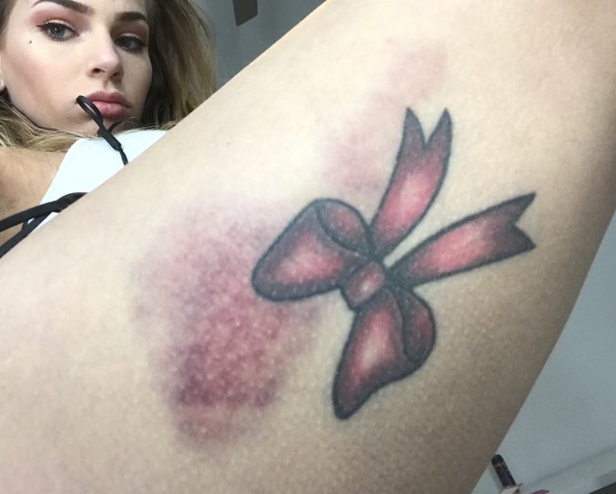 I bruise like a peach :( speaking of 🍑🍑 https://t.co/IV3UviaZIZ<a href="/tag/mvsales"class="tags"><span>#mvsales</span></a>