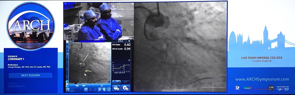 ekgpdx's tweet photo. Great live case using iFR coregistered pullback for planning stent coverage in complex PCI. An alternative to intravascular imaging? #ARCH2018 @SukhNijjer https://t.co/B4plwEDH5O