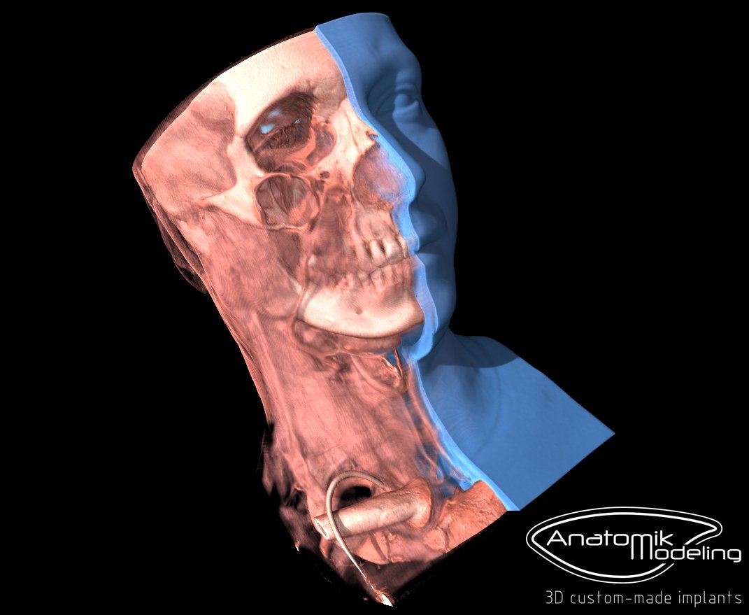 AnatomikM's tweet photo. High performance computing on #xray #ctscan #medical datas and #3dprinting for pre #surgery planning for an extreme face cancer case. https://t.co/q2EMk9abXd