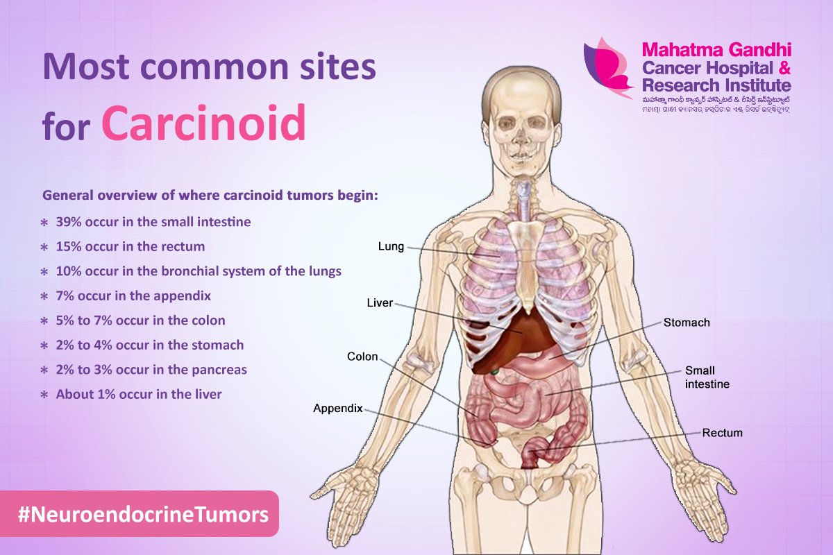 A #carcinoidtumor starts in the hormone-producing cells of various organs, primarily the gastrointestinal tract and lungs, but also the pancreas or rarely other organs. #MGCHRI #CancerHospital