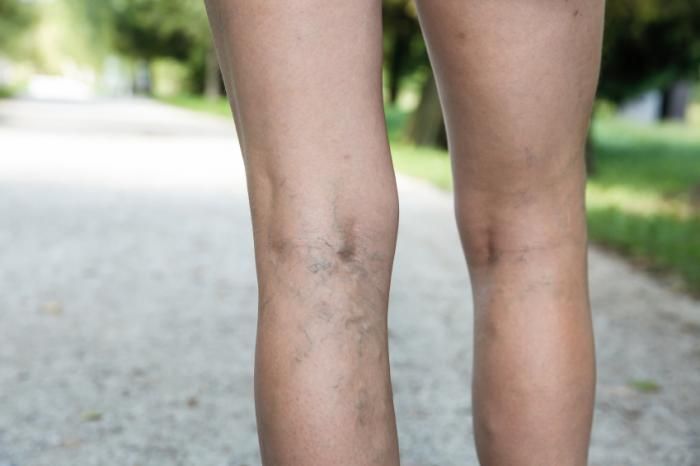 _Preggas's tweet photo. Varicose veins are incredibly common during pregnancy, and usually not harmful in any way. There are several ways to help prevent them, though, mainly through improving 
circulation! https://t.co/9N1EVQ1L7S https://t.co/x8SmKL7f6o