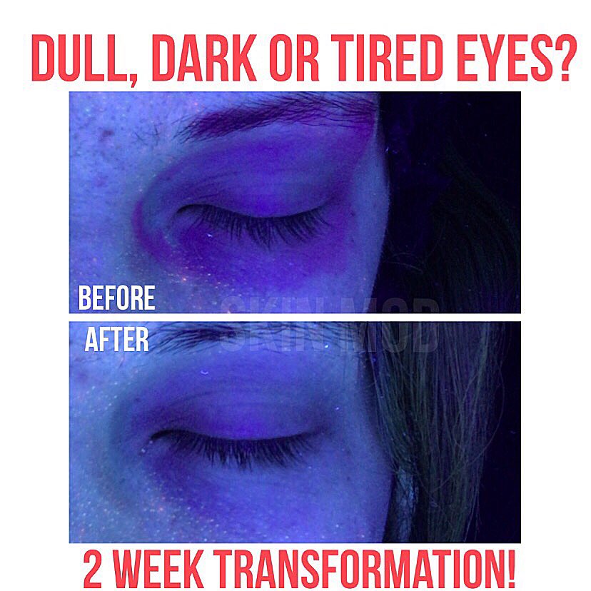 skinmodclinic's tweet photo. 2 week transformation seen under a woods lamp! Don’t just take our word for it, see the results for yourself! •
•
•
#eyes #transformation #darkcircles #bright #antiaging #skinanalysis #aesthetic #beauty #hair #clinic #laser #new #medical #treatyoself #skinmod #london #essex https://t.co/HCpKfqlMff