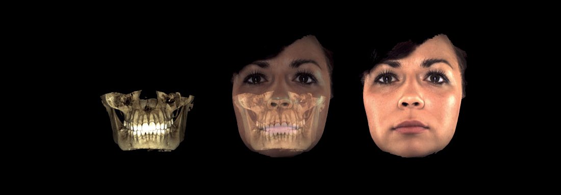 Enjoy the uniqueness of 3D integration with #Planmeca #ProFace™, a unique 3D facial photo option available for all Planmeca’s 3D X-ray units. #digitaldentistry