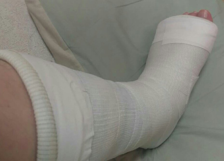 儀宣 ｽﾉﾓﾄ 足首捻って病院行ったら靭帯剥離骨折でした私は今日から足首ギプスですなんてこったい T Co O5gqwbrtid Twitter