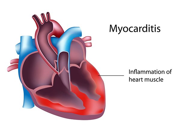 CRT_meeting's tweet photo. #Myocarditis following #ImmuneCheckpointInhibitor (#ICI) #therapy may be more common than previously thought, and can occur early in the course of #cancer #treatment, but it also responds to #higherdose #steroids, #researchers reported.

Read more: https://t.co/SdrmyYe9J0 https://t.co/NY0e7s2cvS