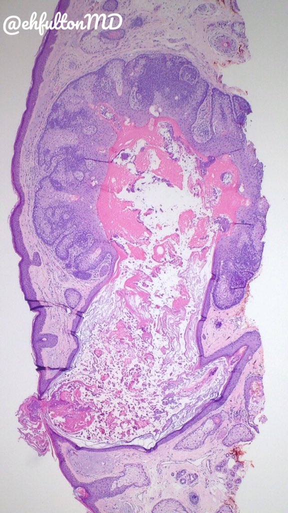 Edward Fulton, MD (@ehfultonmd) on Twitter photo Cystic change in sebaceous lesions may be a risk factor for Muir-Torre-- excellent review below! ncbi.nlm.nih.gov/pmc/articles/P… #dermpath #pathology #dermatology <a href="/MightyDermPath/">Sara Shalin</a> Cystic change in sebaceous lesions may be a risk factor for Muir-Torre-- excellent review below! ncbi.nlm.nih.gov/pmc/articles/P… #dermpath #pathology #dermatology <a href="/MightyDermPath/">Sara Shalin</a>