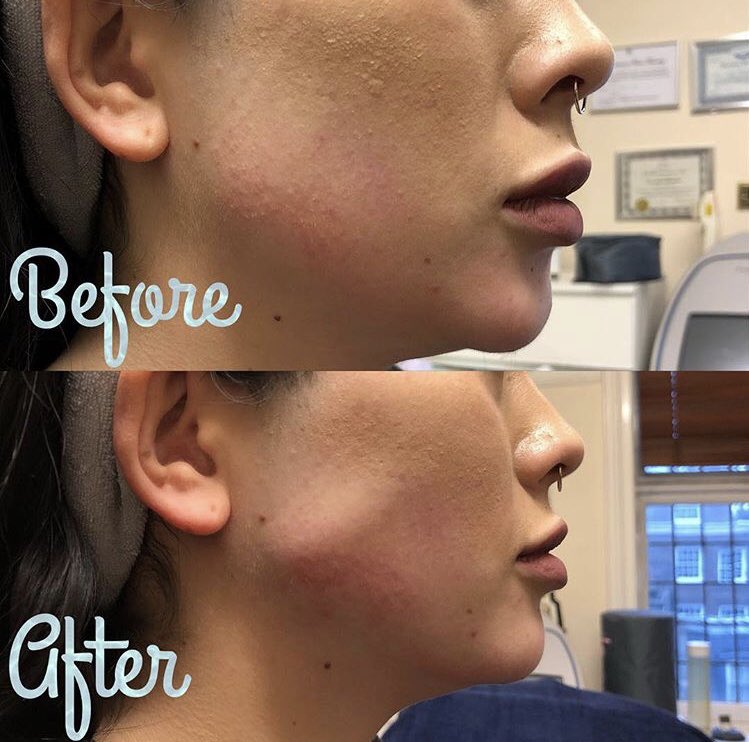 Hello Friday! Our today’s treatment recommendation is jaw line definition. Visit our clinic in Harley Street for a free consultation with our doctor and learn more about our services. 
#jawlineenhancement #jawlinecreation #jawlinedefinition #createajawline #chinfillers #jawfiller