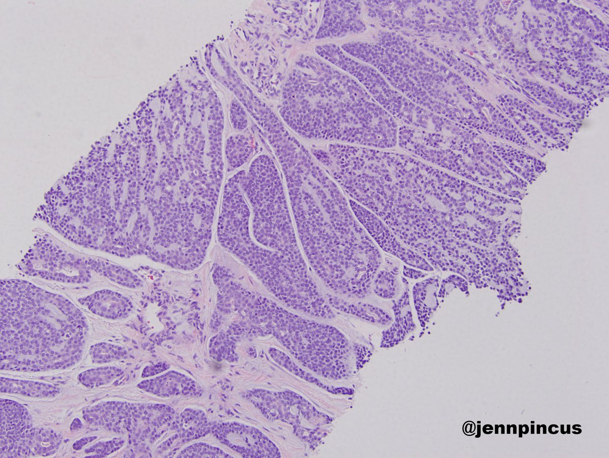jennpincus's tweet photo. These pictures are from a breast mass in a 54 year old female.  What are your thoughts?  Is this a primary or metastatic lesion? #breastpath #pathology https://t.co/i5woNGrfT5