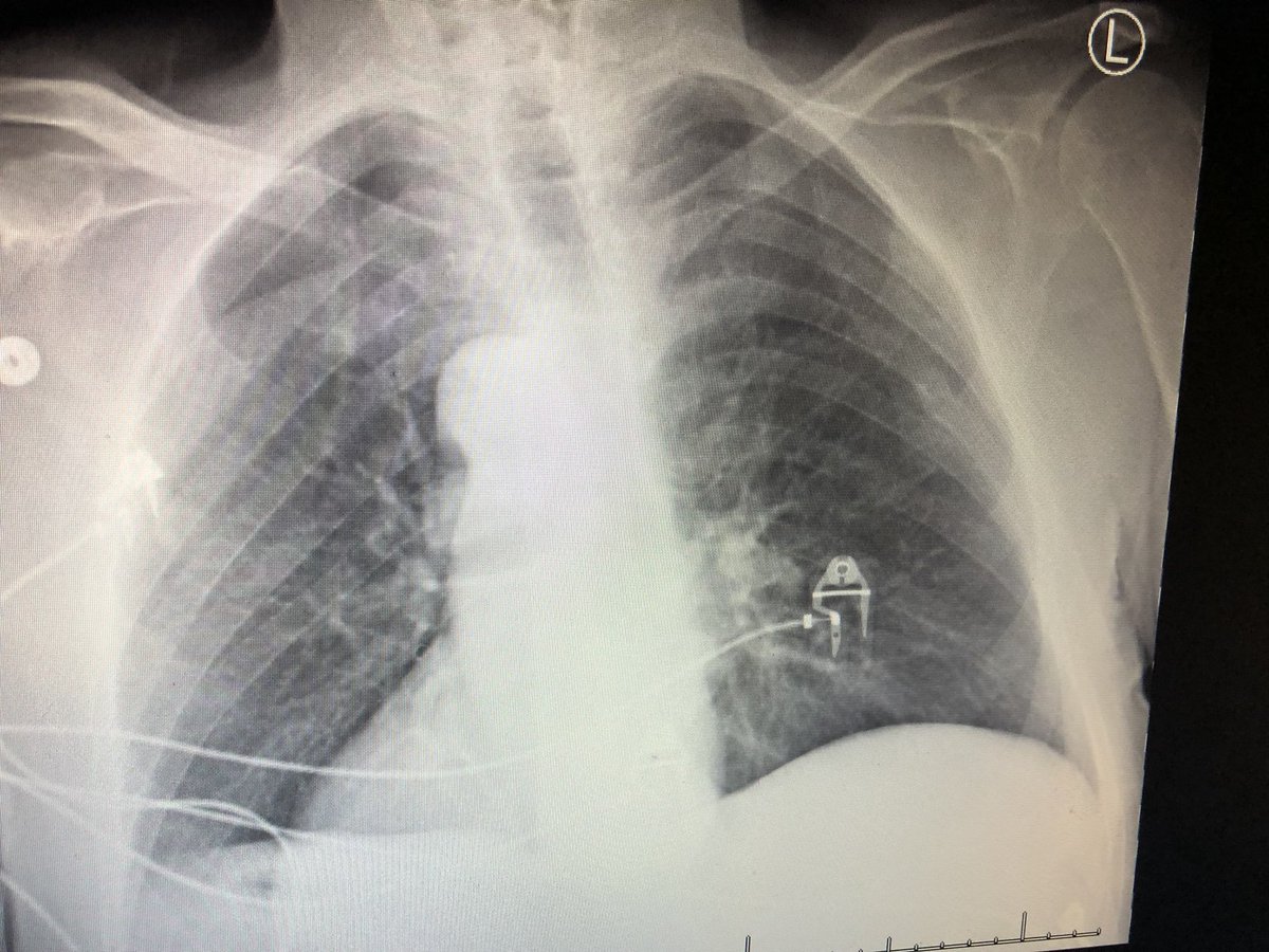 NevdeK's tweet photo. RTR for GIB in Situs Inversus Totalis. Feels like driving in 🇬🇧. #RadialFirst #tsriFlaidaR #FreakyFriday13th https://t.co/9JZTxeV12L