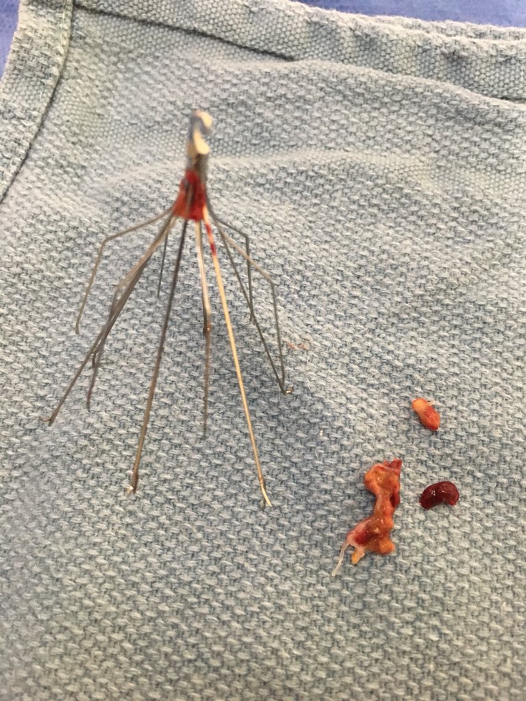 Dan Patel (@danpatelmd) on Twitter photo Filter Friday #GTFO #filterOUT #IRad <a href="/SIRRFS/">SIR RFS</a> <a href="/CWRUSOM/">CWRU School of Medicine</a> <a href="/UHhospitals/">University Hospitals</a> Filter Friday #GTFO #filterOUT #IRad <a href="/SIRRFS/">SIR RFS</a> <a href="/CWRUSOM/">CWRU School of Medicine</a> <a href="/UHhospitals/">University Hospitals</a>