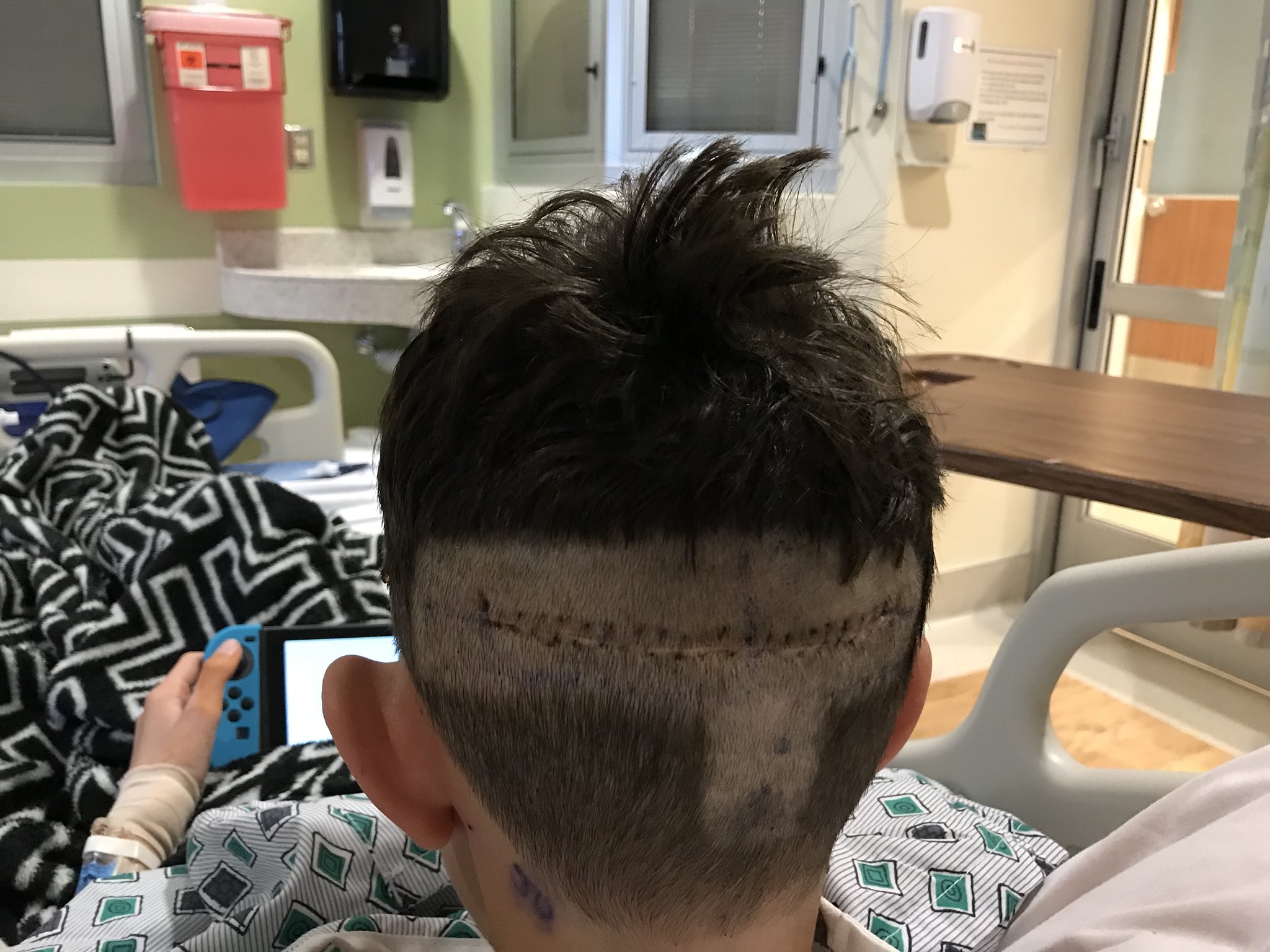 Brain Surgery Scar