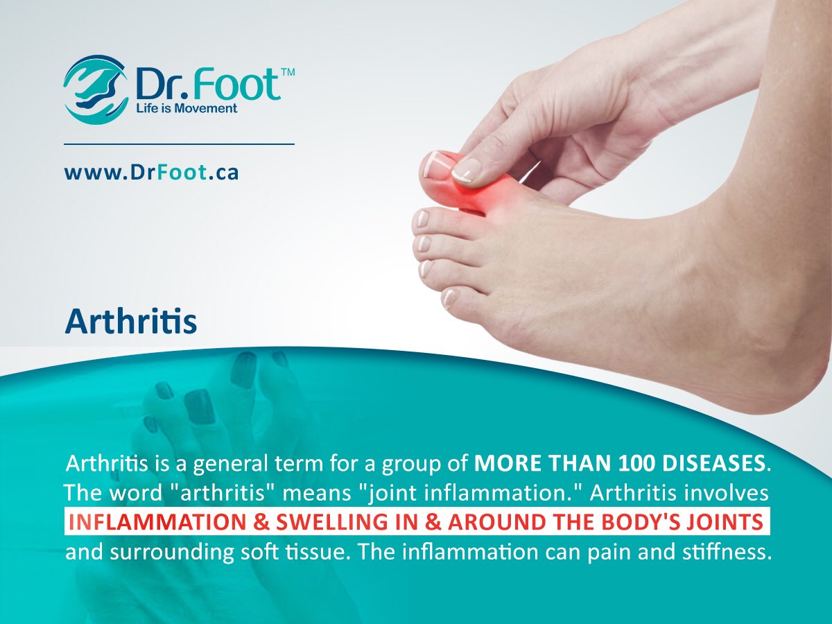 DrFootCanada's tweet photo. What’s the #Arthritis?
#DrFoot
#Clinic
#Foot_Clinic
#Foot
#Foot_Care
#Podiatry
#Podiatrist 
#Chiropractor
#bunion
#Orthopedic_shoes
#Orthotic
#Sport
#Arthritis
#Diabetic_Foot
#Flat_Foot https://t.co/yMWf450jli
