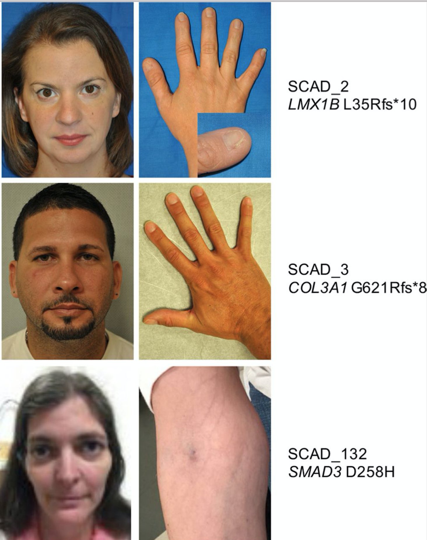 IJMS | Free Full-Text | A Microdeletion of Chromosome 9q33.3 Encompasses  the Entire LMX1B Gene in a Chinese Family with Nail Patella Syndrome