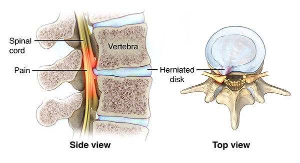 profdrasifbashi's tweet photo. All About Decompression Surgery

https://t.co/UfqlqrZye8 https://t.co/CykEROOl6B