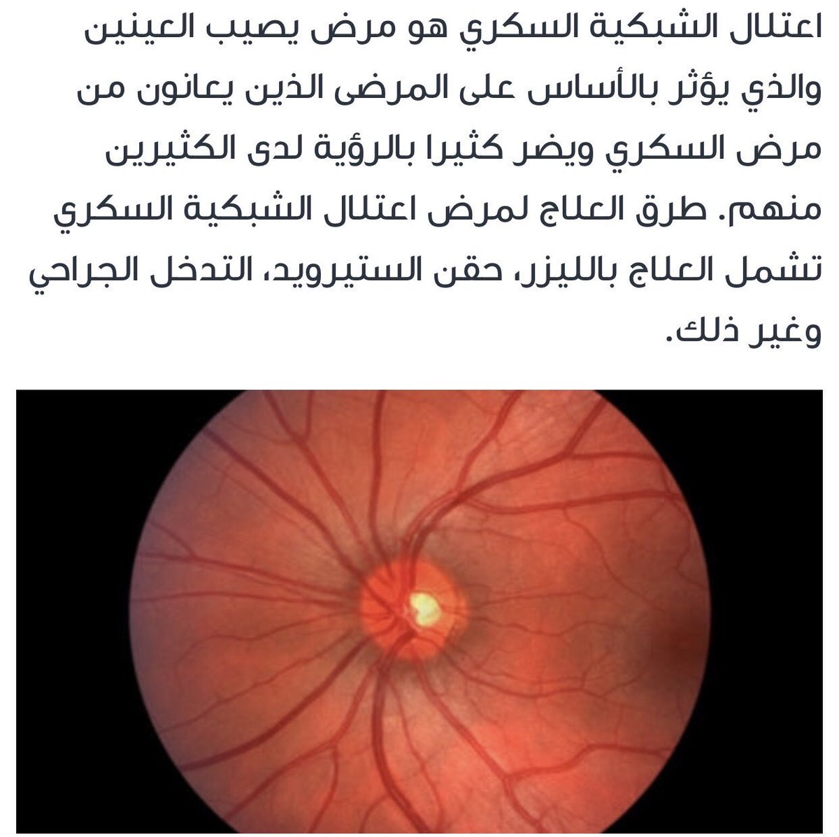 OSC_KAU's tweet photo. #اعتلال_الشبكية https://t.co/zPOyp6ldmb