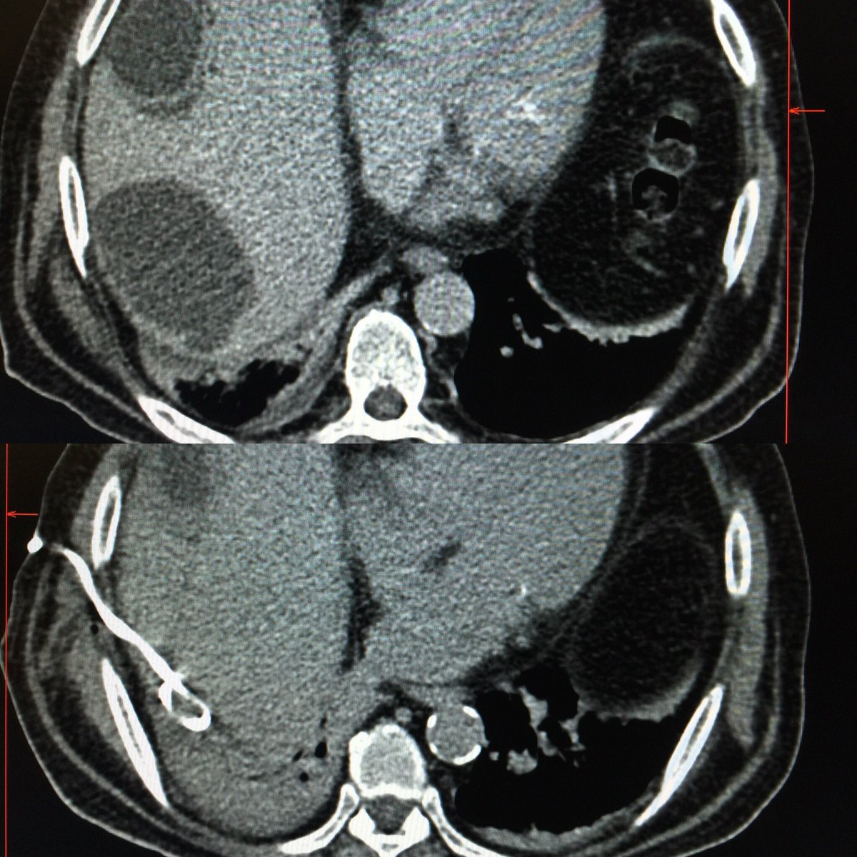 JesusBPMD's tweet photo. Hepatic abscess drainage and thickened gallbladder walls. Today’s case with my mentor @jlriosr #IamIR #SIR #IRad #IRads #IloveIR #InterventionalRad #Hepaticabscess #learning #pathtoIR https://t.co/hOQ8by7pZB