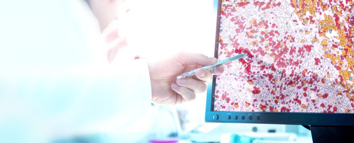 The Definiens Tissue Phenomics® Difference - Standardized Services - IO-Panel, this standardized immune-oncology solution includes 7 key biomarkers for faster turn-around time, and consistent, repeatable results. Learn More at #AACR18 Booth 1423.