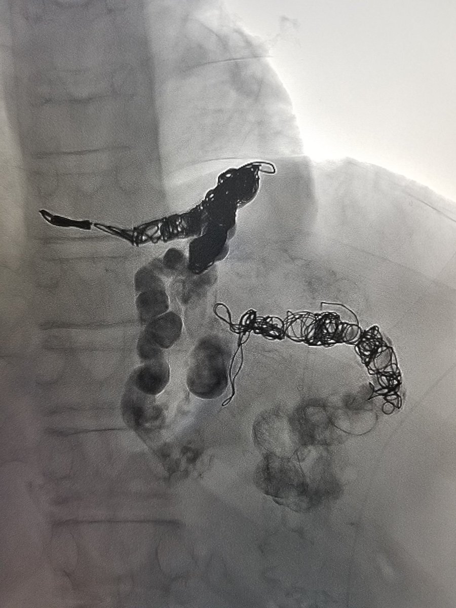 Trans-splenic access into gastric varices with subsequent coil-assisted STS embolization in a young patient with ESLD and portal hypertension (and no spleno-renal shunt).  

#iRad #PedsIR #radiology

#MicrocathetersAreNeat #EmoryIR