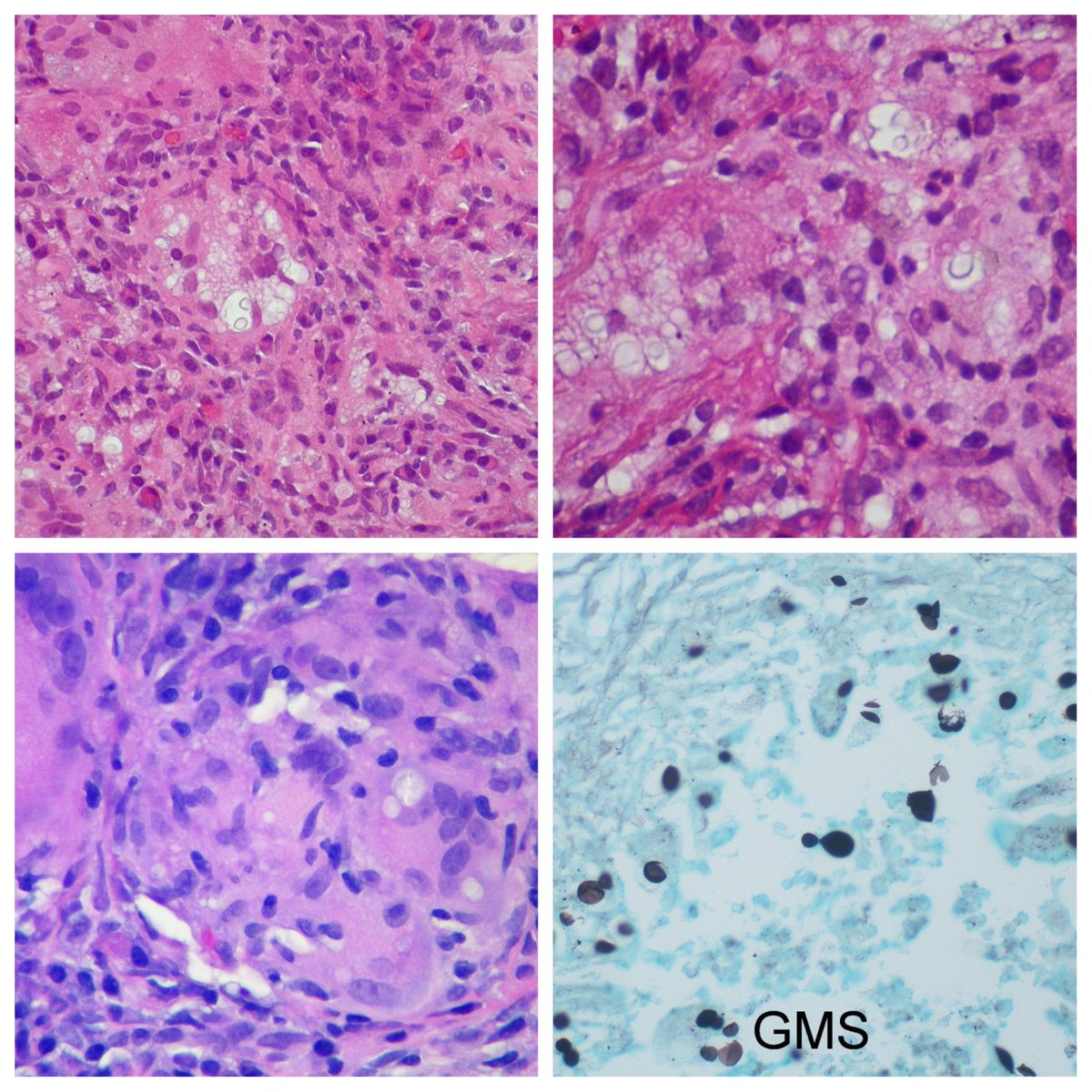 yro854's tweet image. Cryptococcal infection - microscopic
#pulmpath #pathology #cryptococcus #fungi