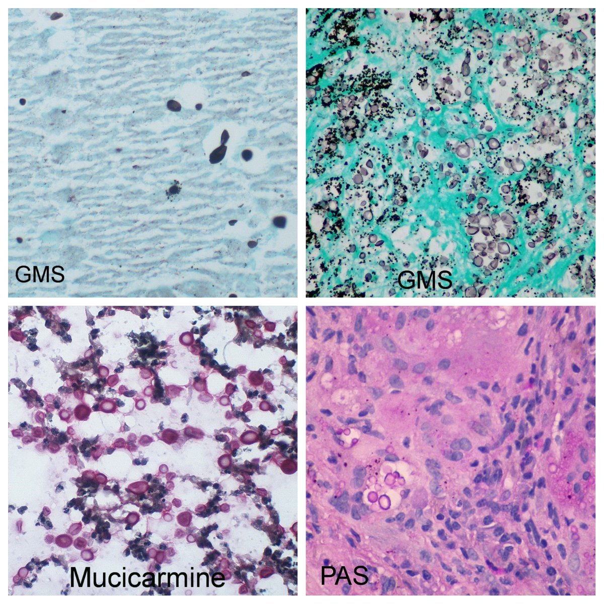 yro854's tweet image. Cryptococcal infection - microscopic
#pulmpath #pathology #cryptococcus #fungi