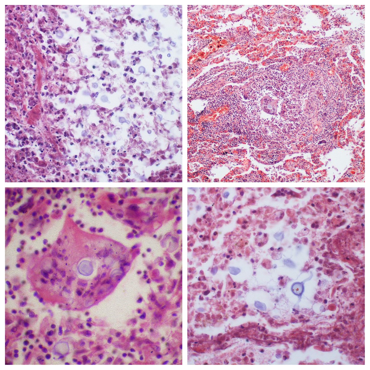 yro854's tweet image. Cryptococcal infection - microscopic
#pulmpath #pathology #cryptococcus #fungi