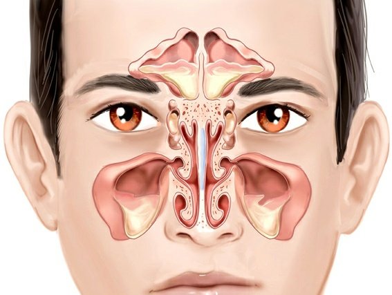 Частая заложенность носа. Параназальный синусит. Гайморит синусит пазухи. Синусит верхнечелюстной пазухи.