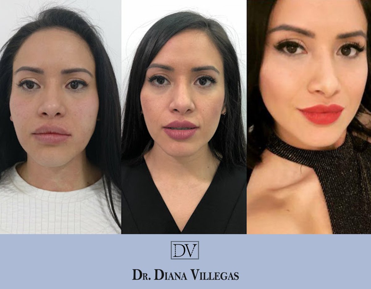 Pomulos marcados antes y despues de adelgazar Pomulos marcados antes y despues de adelgazar