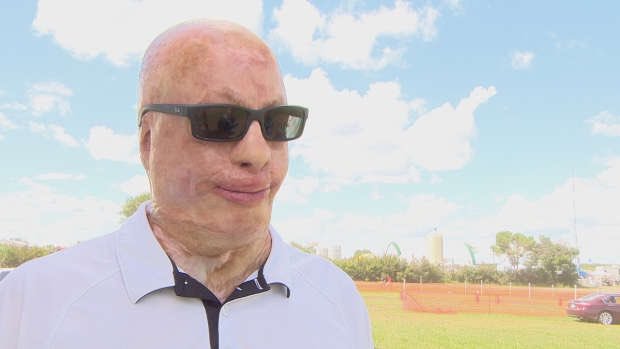 LiveOnCanada's tweet image. How donated skin saved Spencer Beach's life #PledgeToSaveLives @LiveOnRegithon &amp;amp; Live On!
cbc.ca/1.4638555