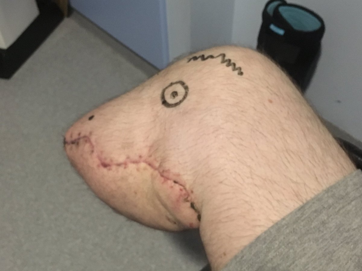 benperry_2001's tweet photo. After it was seeing my stump that triggered my meltdown earlier, I’ve embraced it and turned it into something positive...
Introducing Stumpy the dinosaur 🦖 #amputee https://t.co/3qe1qNslhu
