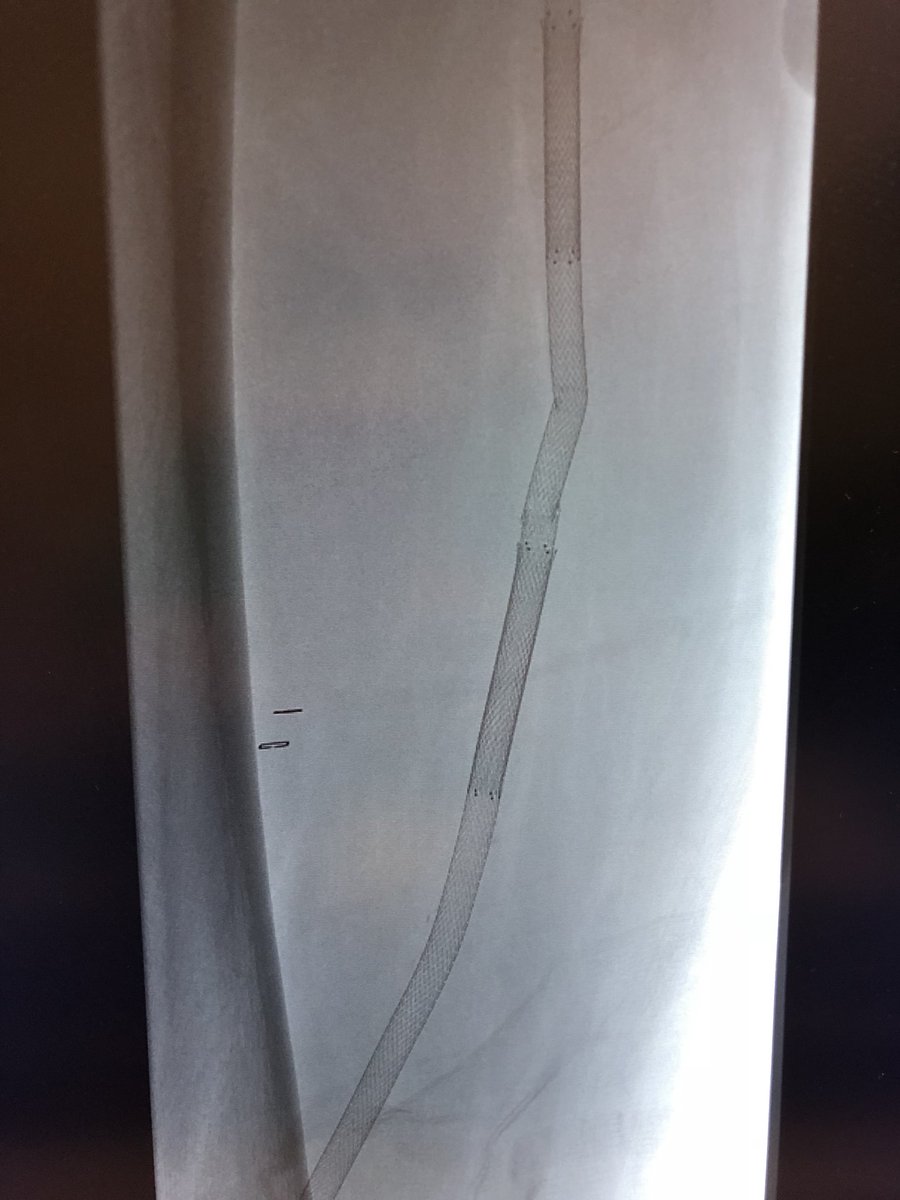 CUVascularSurg's tweet photo. Stent fractures can be a real problem! @CUVascularSurg @ColoradoIR @UWVascsurg @StanfordSurgery @BCM_Surgery @jmills1955 @UWVascsurg @JBiomech @CAVE_Toronto #anatomyofasureon #wireup https://t.co/N76eVQmYu1