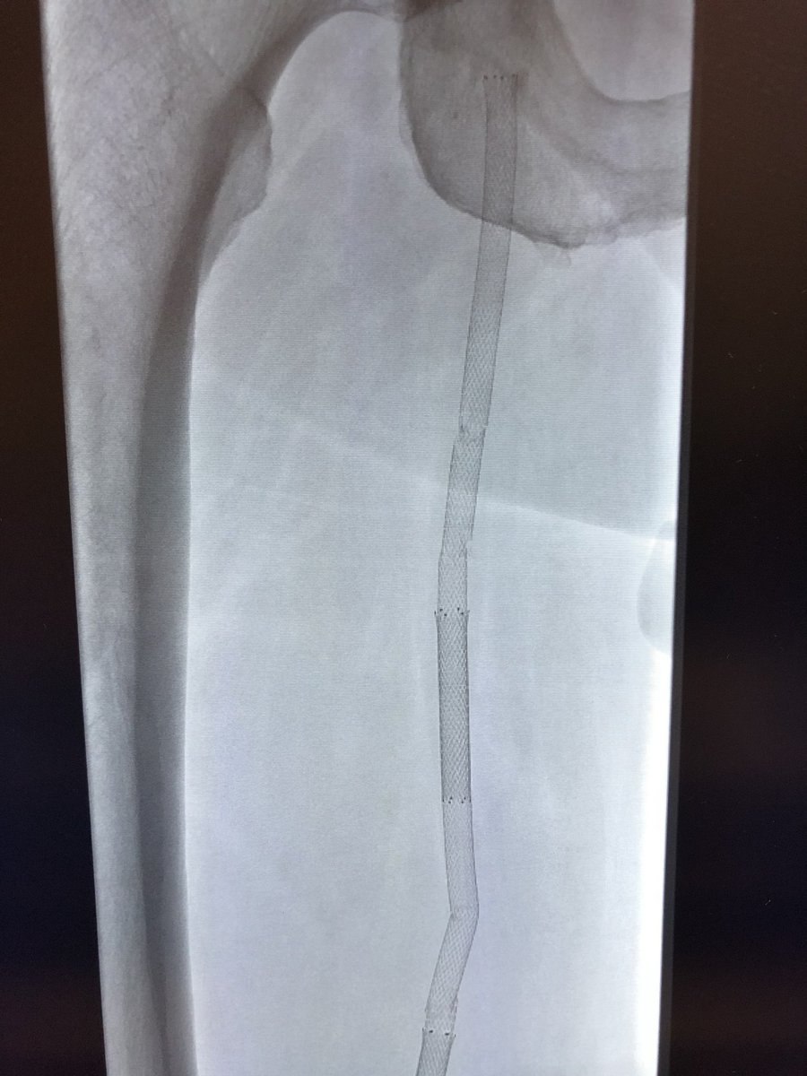 CUVascularSurg's tweet photo. Stent fractures can be a real problem! @CUVascularSurg @ColoradoIR @UWVascsurg @StanfordSurgery @BCM_Surgery @jmills1955 @UWVascsurg @JBiomech @CAVE_Toronto #anatomyofasureon #wireup https://t.co/N76eVQmYu1