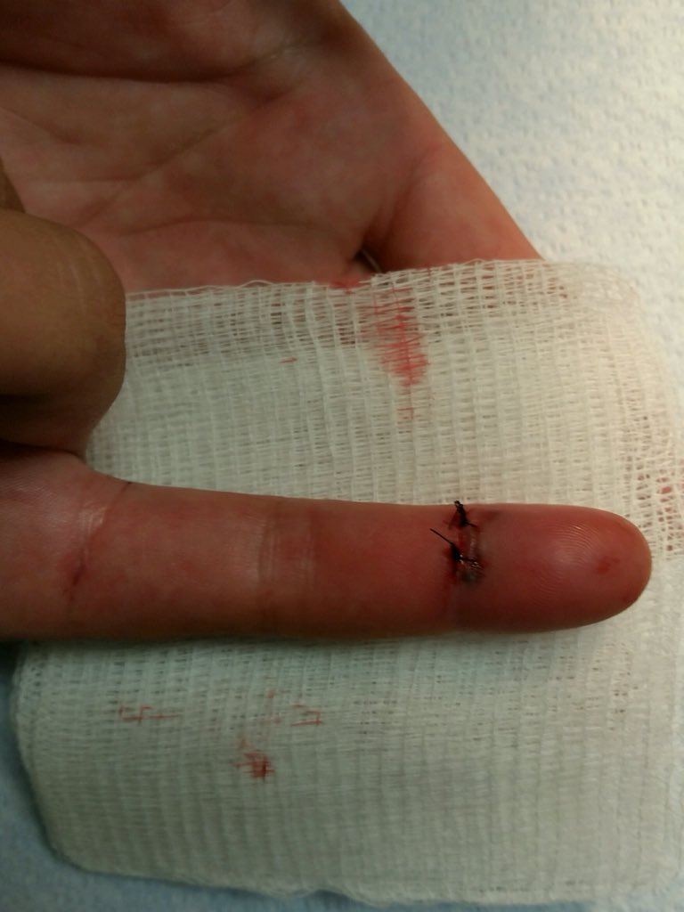 marissakostick's tweet photo. Update on my luck: right pointer finger #LUsoftball https://t.co/u2ZAdi1PcR