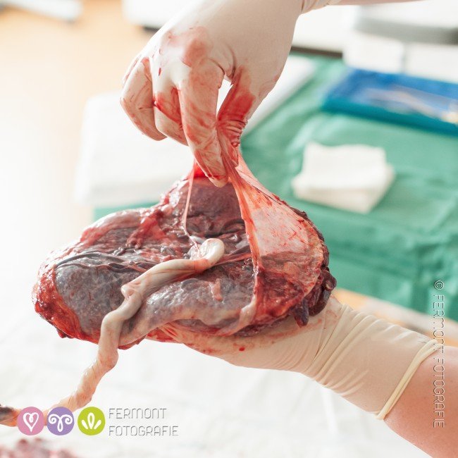 babywaze's tweet photo. Incredible photos showcase the wonder of the placenta https://t.co/ejfDUe1pfL https://t.co/52SRgSubtS