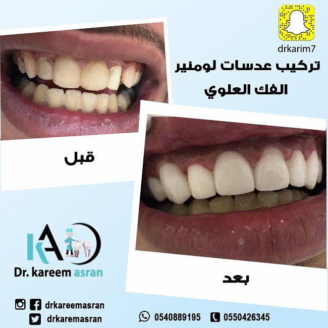 احصل على #العدسات_التجميلية #اللومينير
الان بـيوم #واحد و في #جلسة_واحدة
لدى #الدكتور #كريم_عسران

#عدسات_اسنان
#تركيبات_اسنان
#اسنان_نظيفة