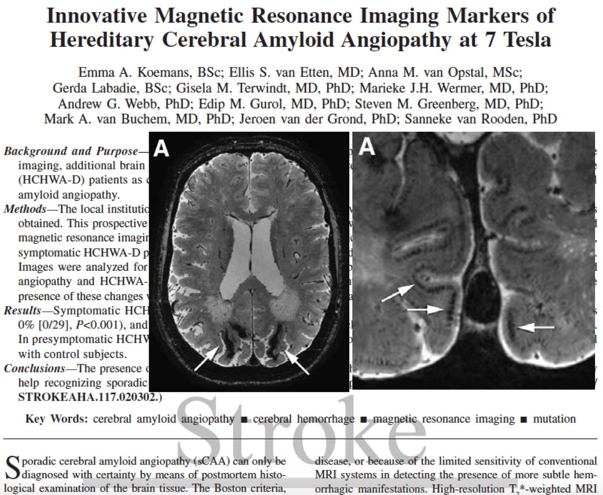 Edip Gurol (@guroledip) on Twitter photo Novel 7 Tesla MR imaging markers of cerebral amyloid angiopathy - insights from a hereditary <a href="/CAA_Disease/">Amyloid Angiopathy</a> cohort: intragyral hemorrhage, striped cortex sign <a href="/LUMC_Leiden/">LUMC Leiden</a> <a href="/norocardiology/">NeuroCardiology</a> <a href="/AHAScience/">AHA Science</a> <a href="/StrokeAHA_ASA/">Stroke AHA/ASA</a> bit.ly/2r73F2N Novel 7 Tesla MR imaging markers of cerebral amyloid angiopathy - insights from a hereditary <a href="/CAA_Disease/">Amyloid Angiopathy</a> cohort: intragyral hemorrhage, striped cortex sign <a href="/LUMC_Leiden/">LUMC Leiden</a> <a href="/norocardiology/">NeuroCardiology</a> <a href="/AHAScience/">AHA Science</a> <a href="/StrokeAHA_ASA/">Stroke AHA/ASA</a> bit.ly/2r73F2N