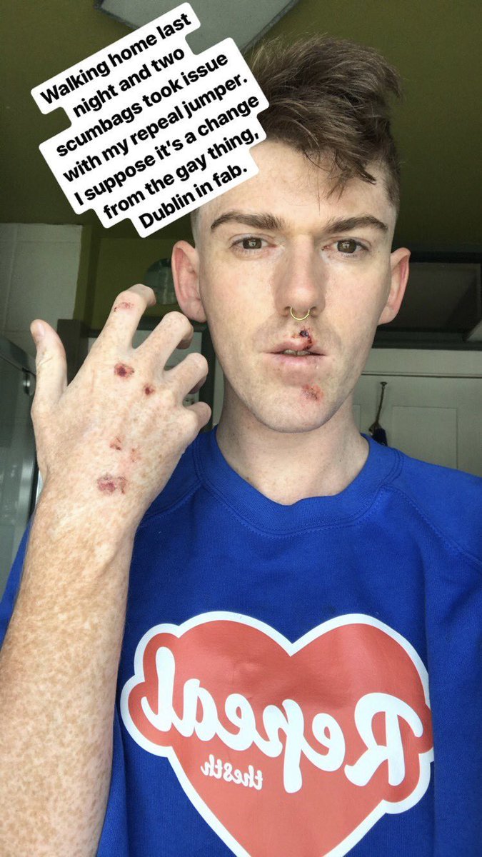 LGBTforChoice's tweet photo. One of our members of LGBTQ community attacked for wearing #repealthe8th tee-shirt last night #Together4Yes https://t.co/n3NFFoU05W