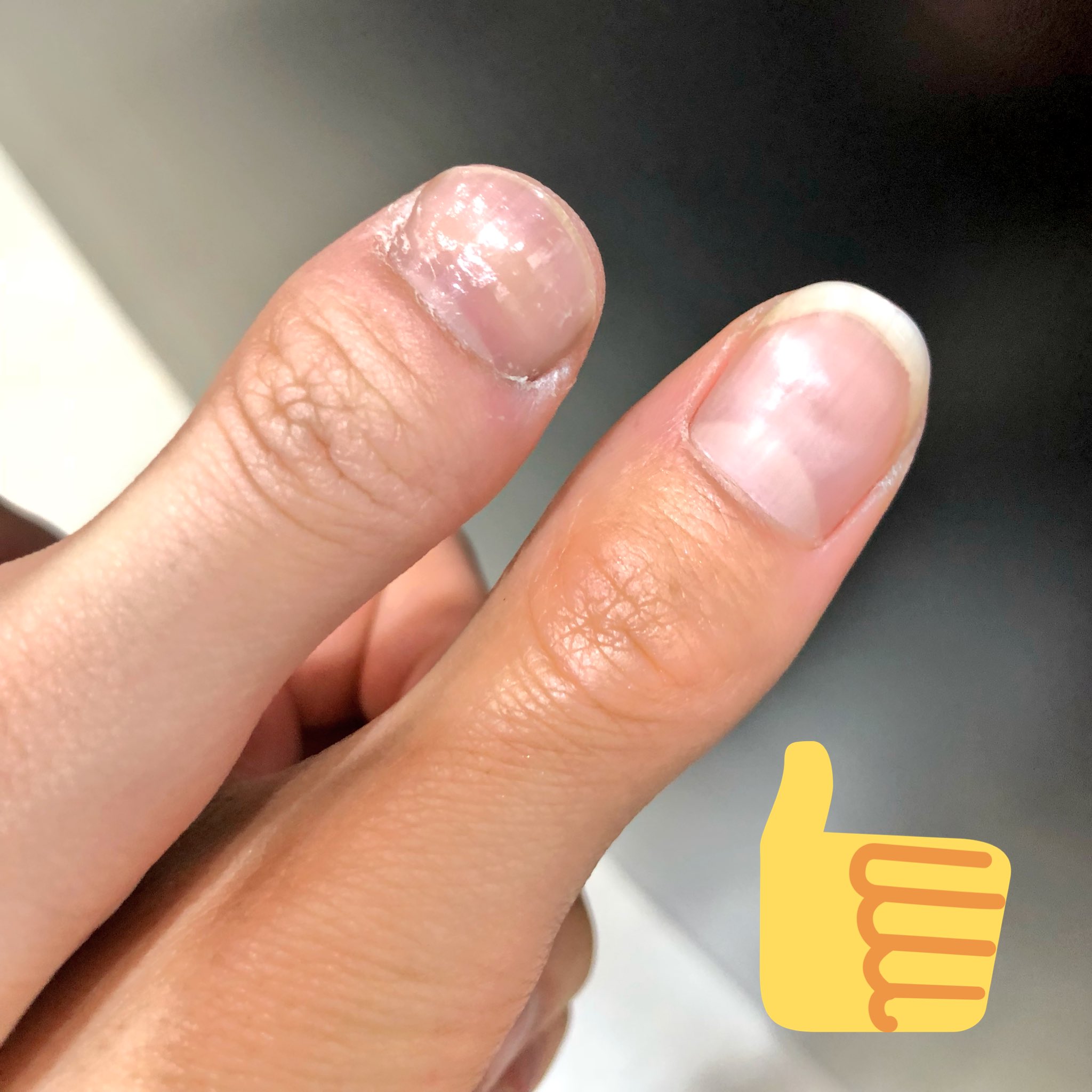 Twitter 上的 川村 海里 Ds浦和コルソ店 いや やっぱふつーに わたしの親指変だよね 一周回ってもはや可愛い 笑 実はこの指ね 1万人に1人の確率なんだよ すごくない マムシ指 短指症 T Co Uju7yuxvlh Twitter