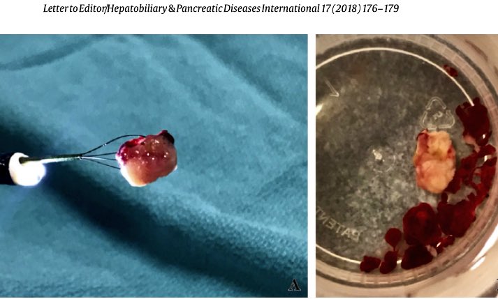 THealeyIRad's tweet photo. #Patients with obstructive jaundice secondary to Intraductal papillary neoplasm of the bile duct? Interested in how to use #IREndoscopy to treat this cohort?? Hot off the press! https://t.co/PWikDWFpfn @CHICKVIR @medravi @iRadRaj @IRadLab #IRad #WithoutAScalpel @SIRspecialists https://t.co/Xq6krDivjQ
