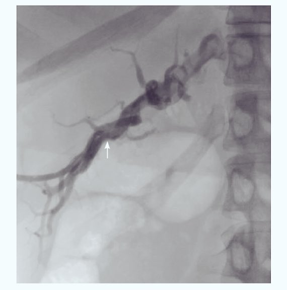 THealeyIRad's tweet photo. #Patients with obstructive jaundice secondary to Intraductal papillary neoplasm of the bile duct? Interested in how to use #IREndoscopy to treat this cohort?? Hot off the press! https://t.co/PWikDWFpfn @CHICKVIR @medravi @iRadRaj @IRadLab #IRad #WithoutAScalpel @SIRspecialists https://t.co/Xq6krDivjQ