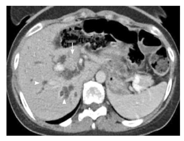 THealeyIRad's tweet photo. #Patients with obstructive jaundice secondary to Intraductal papillary neoplasm of the bile duct? Interested in how to use #IREndoscopy to treat this cohort?? Hot off the press! https://t.co/PWikDWFpfn @CHICKVIR @medravi @iRadRaj @IRadLab #IRad #WithoutAScalpel @SIRspecialists https://t.co/Xq6krDivjQ