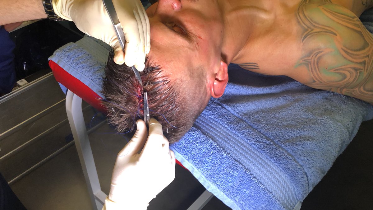 Fenerbahce's tweet photo. Oyuncumuz Martin Skrtel’in kafa topu mücadelesi sırasında almış olduğu darbe sonucu yarasına ilk müdahale kulüp doktorumuz tarafından soyunma odasında gerçekleştirildi. Geçmiş olsun Martin Skrtel. https://t.co/2gortxJ6eo