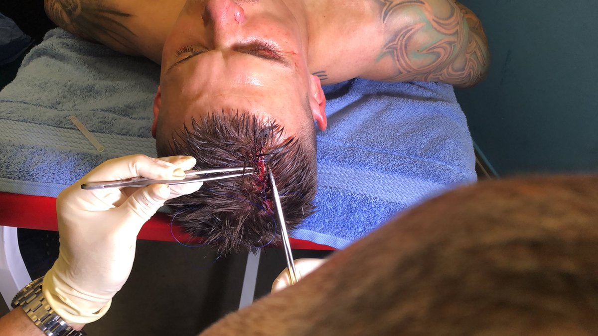 Oyuncumuz Martin Skrtel’in kafa topu mücadelesi sırasında almış olduğu darbe sonucu yarasına ilk müdahale kulüp doktorumuz tarafından soyunma odasında gerçekleştirildi. Geçmiş olsun Martin Skrtel.