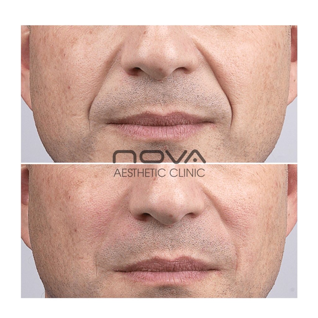 ✨DERMAL FILLER at Nova✨ Filler can be used to soften and fill deep wrinkles resulting in a more youthful looking face. At Nova we have both female and male clients who come to us to help them look and feel their very best. #greenwich #dermalfiller #london #beauty #aesthetics
