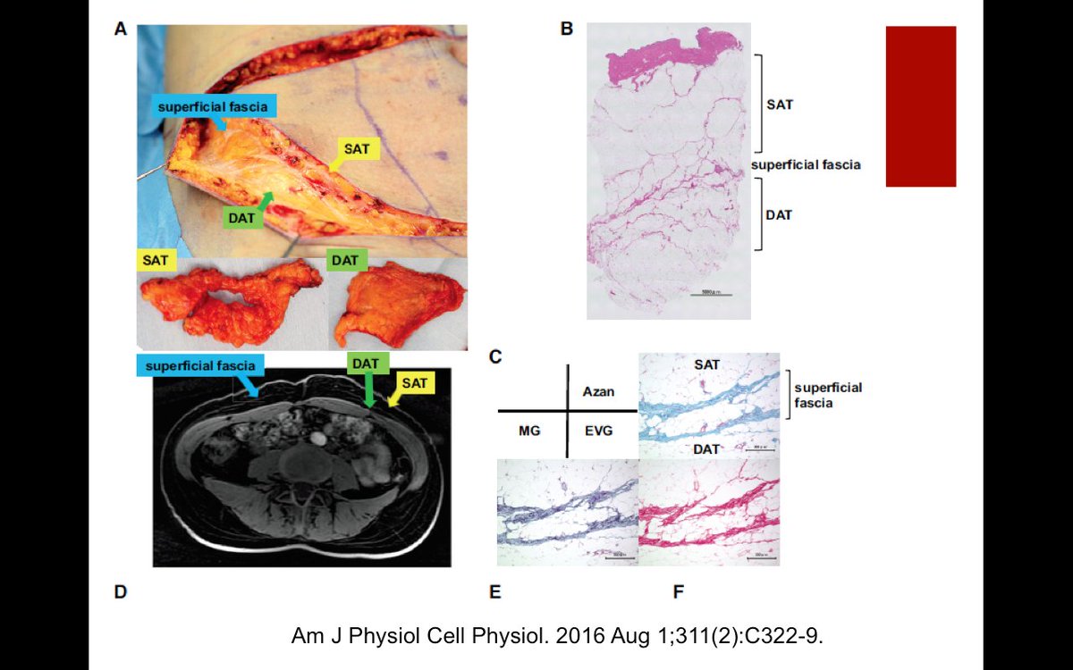 El tejido #adiposo subcutaneo no se comporta igual metabolicamente que el visceral, pero no todo el #subcutaneo es igual, la capa profunda es más parecida al visceral que al subcutaneo clásico.  #sediab18 La #obesidad es una enfermedad compleja y diversa