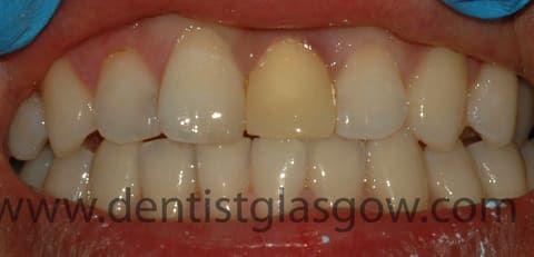 DentalAppletree's tweet photo. It is one of the toughest job in dentistry - fitting a single central incisor crown when everyone can see it. Getting a match is crucial. Find out how this Glasgow patient got on. https://t.co/0f3CP9SLnj https://t.co/mg0QWxTAgv