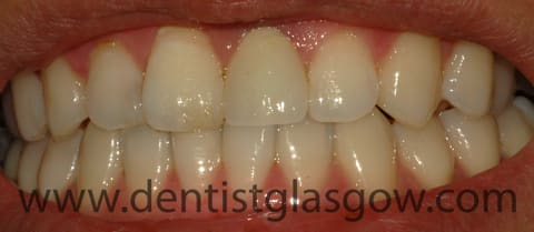 DentalAppletree's tweet photo. It is one of the toughest job in dentistry - fitting a single central incisor crown when everyone can see it. Getting a match is crucial. Find out how this Glasgow patient got on. https://t.co/0f3CP9SLnj https://t.co/mg0QWxTAgv