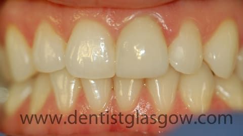 DentalAppletree's tweet photo. Charlene came to our Glasgow dental practice complaining of a dark front tooth. We solved her problem with a really natural-looking dental crown made in the lab from pressed porcelain. https://t.co/BGuSYaHFua https://t.co/BduSL8w8XJ