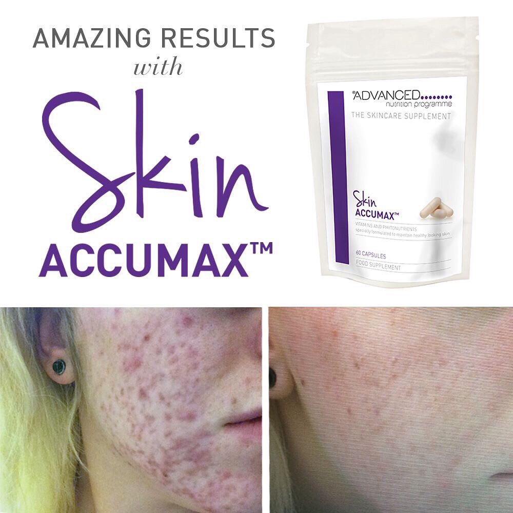 WxSkinClinic's tweet photo. #natural #treatment for #acne #rosacea #breakouts @UK_ANP #skinaccumax https://t.co/Rn0sF5w3QY