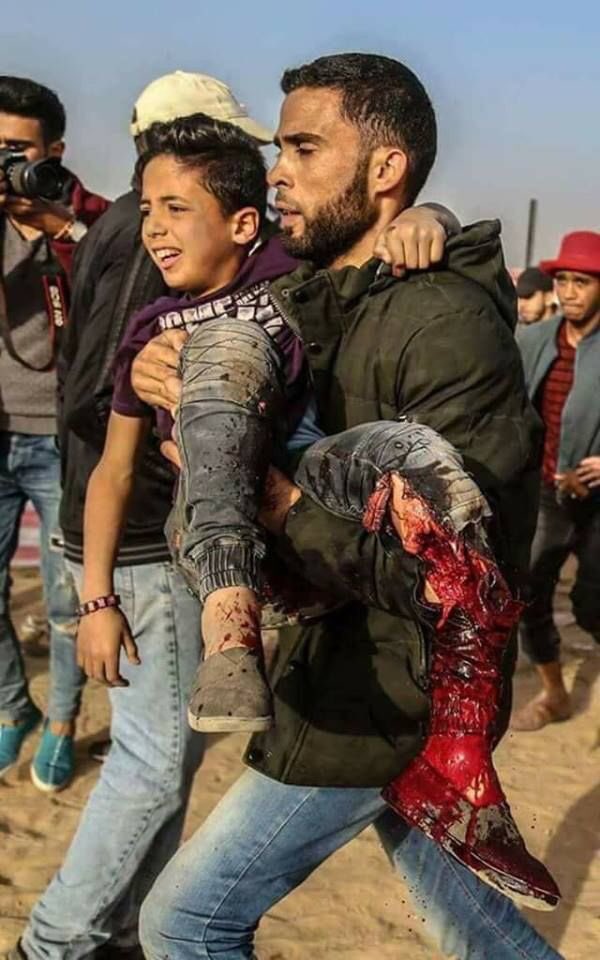 MohammadMusle18's tweet photo. israel's use of internationally prohibited exploding bullets on unarmed civilians, is a war crime.

#IsraeliCrimes #EndIsraeliOccupation https://t.co/UA2MUW1otY